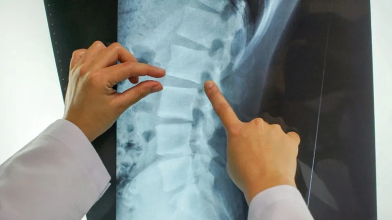 La Cámara de Apelaciones de Neuquén confirmó que una aseguradora deberá indemnizar a un camionero de 33 años, cuya columna presenta el desgaste de una persona de 60.