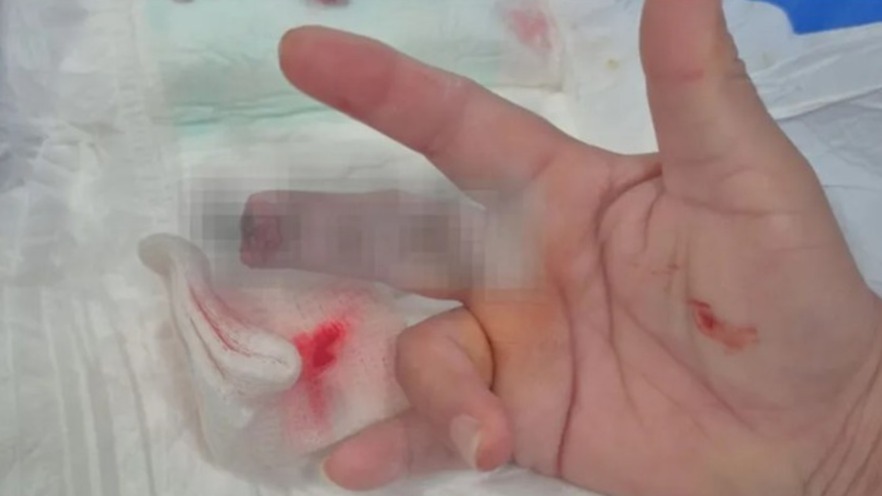 Sucedió el miércoles por la madrugada en General Pinedo, oeste de la provincia. El agresor estaba bajo efectos de sustancias y quedó detenido, mientras que la enfermera sufrió una amputación traumática.